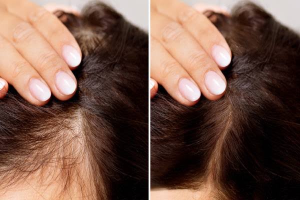 hair fall causes